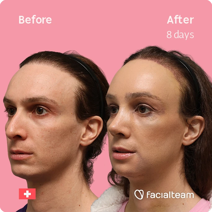 Before and after side-by-side portrait of a woman's face, showing cosmetic improvements after 8 days; pink background, Facialteam branding.