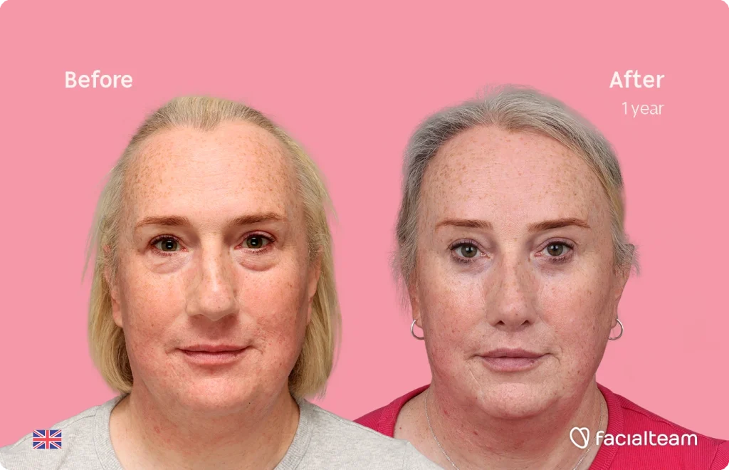 Side-by-side before-and-after portrait of a woman: 'Before' on the left and 'After 1 year' on the right, showing improved skin texture and reduced redness against a pink background.