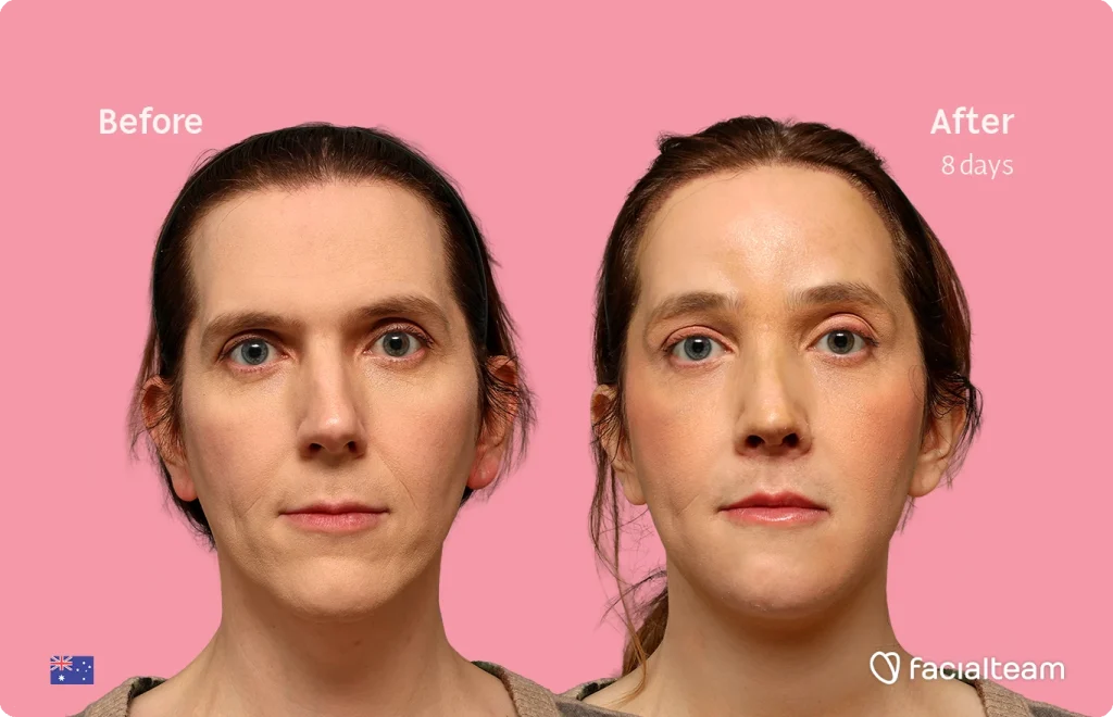 Side-by-side photos of a woman's face on a pink background, labeled 'Before' and 'After 8 days', showing skin improvement and a smoother complexion by Facelteam.