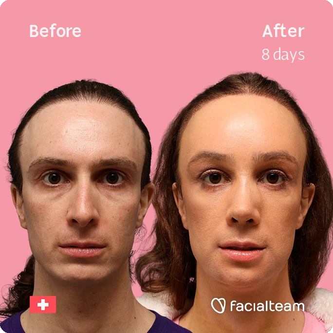 Before and after comparison of a woman's face showing skin improvement; After image labeled '8 days' with a pink background, Facailteam branding bottom right and a small Swiss flag icon bottom left.