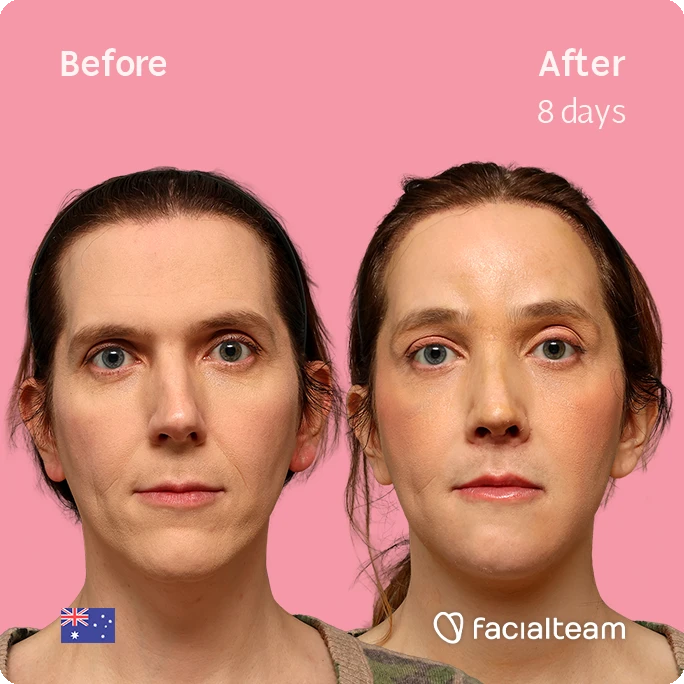 Before (left) and after 8 days (right) of facial treatment, showing smoother, more even skin tone on a pink background with the Facialteam logo.