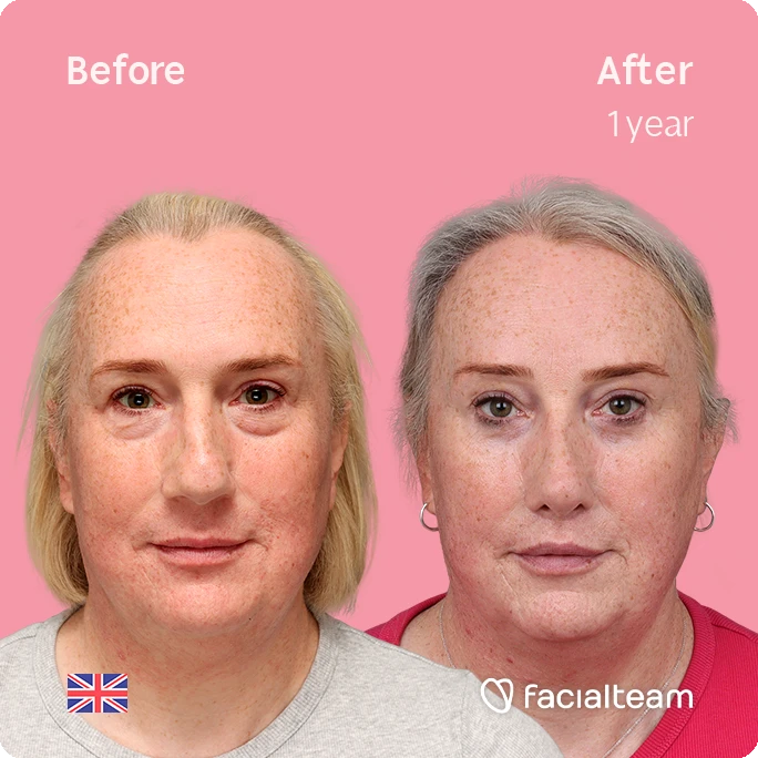 Side-by-side portrait showing a woman before and after one year of treatment; left labeled 'Before' with reddish freckles, right labeled 'After 1 year' with lighter, smoother skin on a pink background. Facialteam logo present.