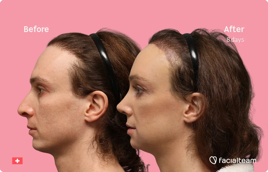 Side-by-side profile of a woman before and after cosmetic treatment, with a pink background and 'Before'/'After' labels.