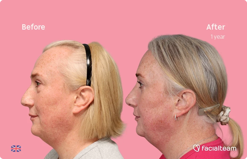 Side-by-side profiles of a woman's face before and after facial rejuvenation, pink background. 1 year.