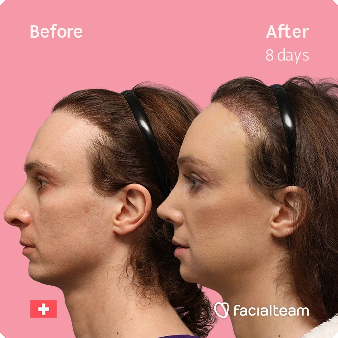 Split-screen profile photos of a woman: Before (left) and After 8 days (right), showing facial changes from treatment; pink background.