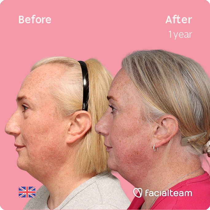 Side-by-side profile shots of a woman before (left) and after one year of treatment, showing reduced redness and improved skin texture against a pink background (Facialteam logo).
