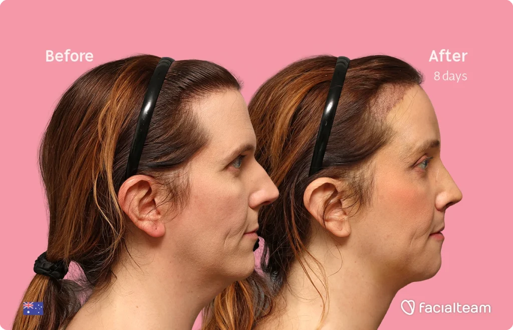 Side-by-side profile of a woman before (left) and after 8 days (right) of facial treatment on a pink backdrop, facialteam logo in corner.