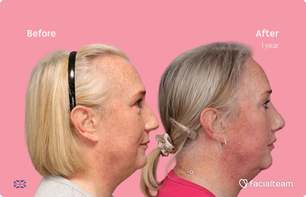 Side-by-side profile photo showing a woman before (left) and after 1 year (right) of a cosmetic treatment, with pink background.