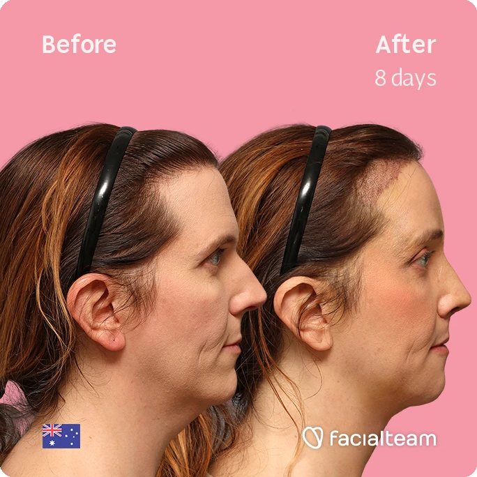 Side-by-side profile of a woman showing cosmetic procedure results: left 'Before', right 'After 8 days', pink background, faces improved jawline; Facailteam branding and Australian flag.