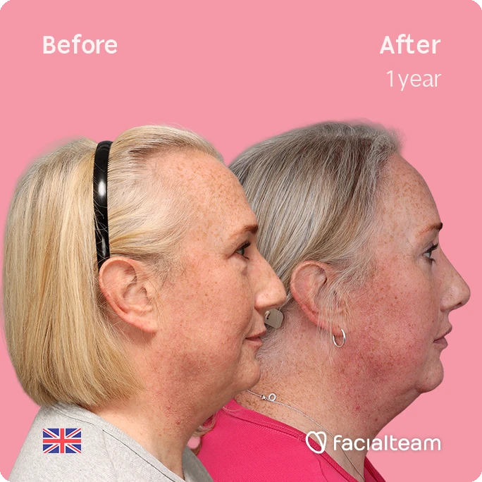 Before/after side-profile photos of a woman; one year after treatment shows a tighter jawline and reduced neck fullness, pink backdrop, Facialteam logo. UK flag in corner.