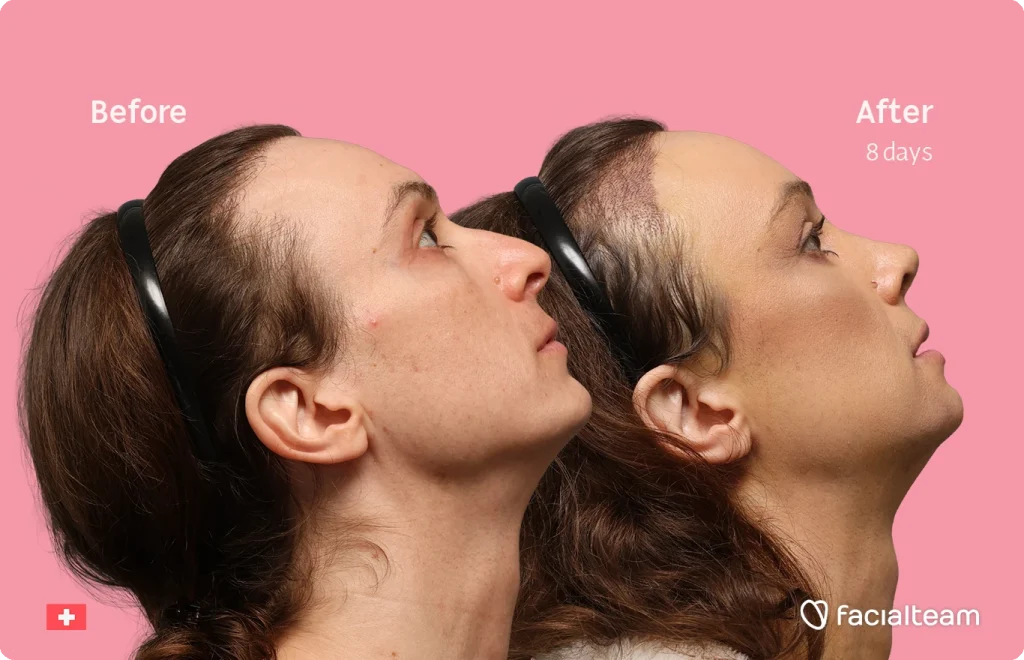 Side-by-side profile photos of a woman before (left) and after 8 days of facial treatment, on a pink background with the Facial Team logo.