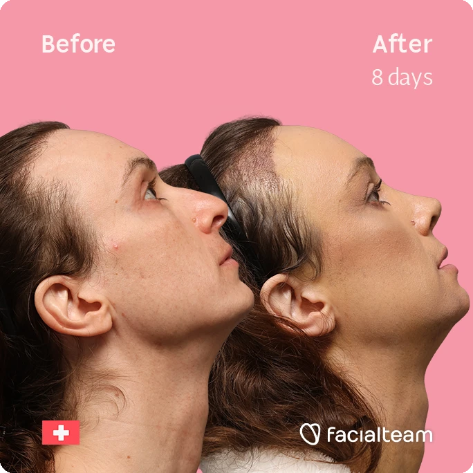Side-by-side profile photos showing facial improvement after 8 days, with 'Before' on the left and 'After 8 days' on the right, pink background.