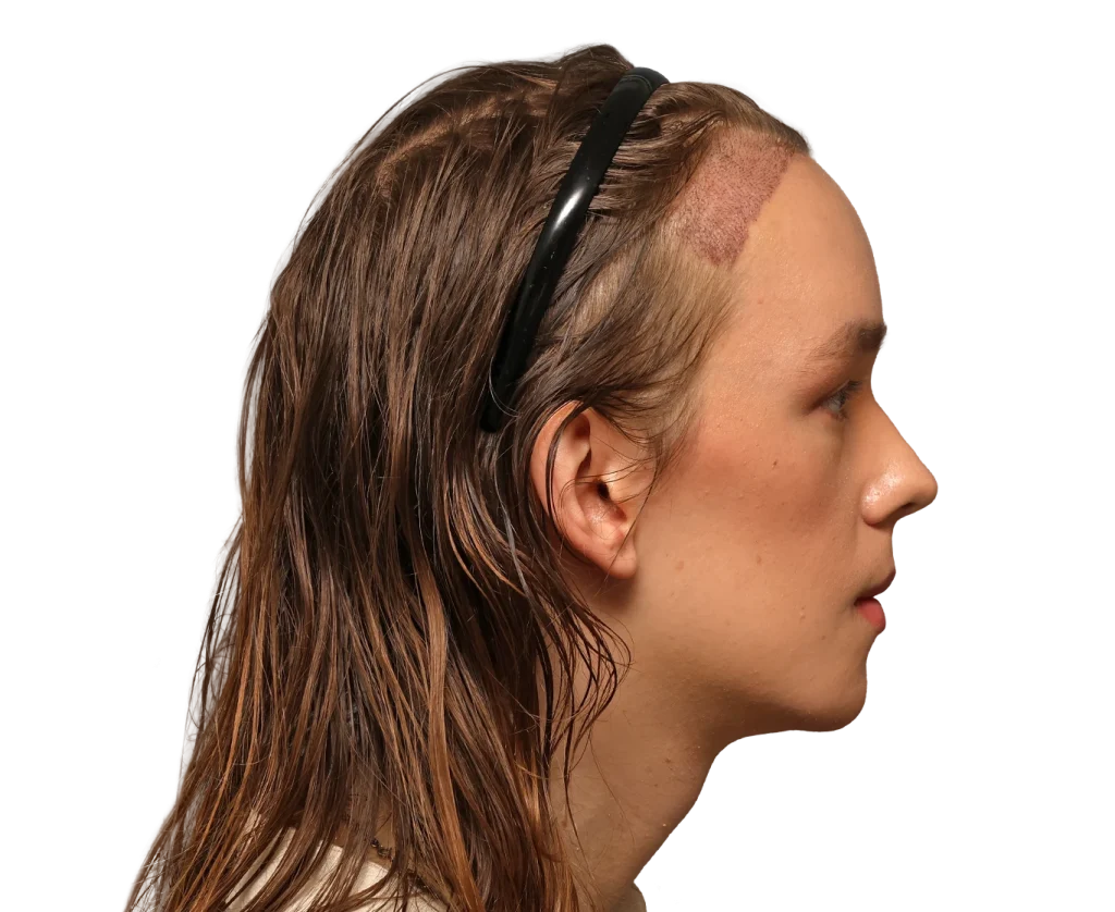Profile view of Zoey with a large scalp scar along the temple, hair held back by a headband