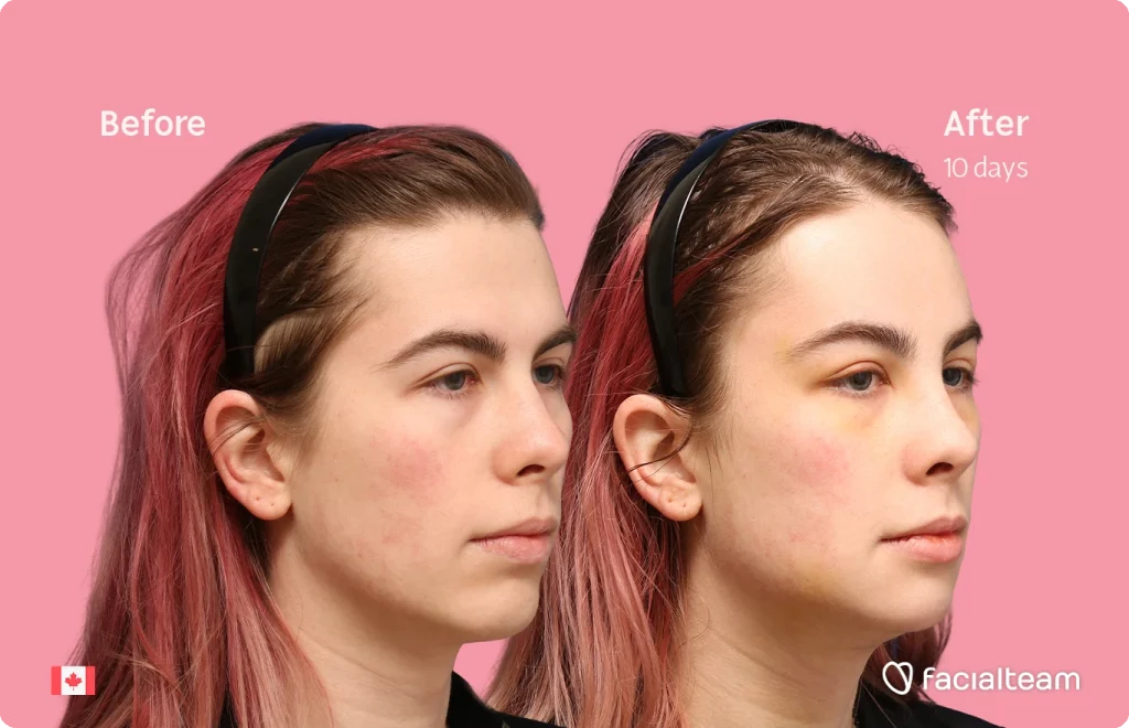 Before and after comparison of Elléonore's face—left shows the before condition, right shows after 10 days, pink background, facialteam branding.