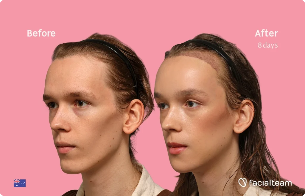 Before-and-after comparison of Zoey's face showing improved hairline two sides on a pink background; left: thinner hair, right: fuller hair at 8 days (Facialteam)