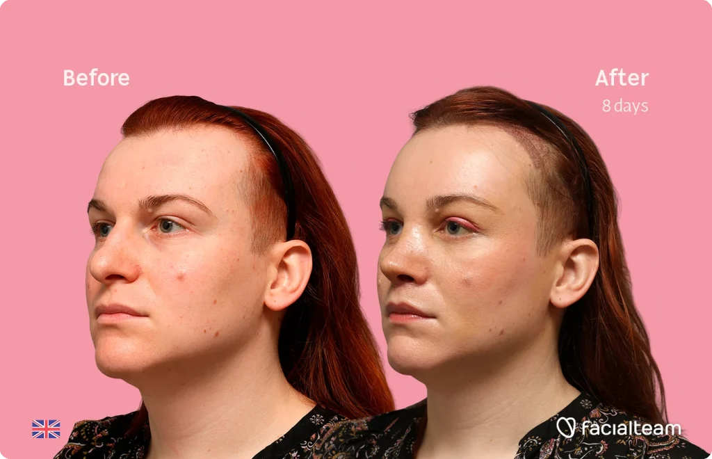 Side-by-side portrait showing a 'before' (left) and 'after 8 days' (right) view of a Mia's face, pink background, facial enhancements evident on the right.