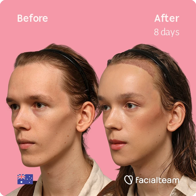 Before and after facial treatment: left image shows initial profile, right image shows healing incisional line at hairline after 8 days, pink background, Facialteam branding.