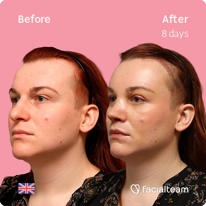 Side-by-side photo of Mia face on pink background, left labeled Before and right labeled After 8 days, showing improved skin texture with less redness and acne marks.