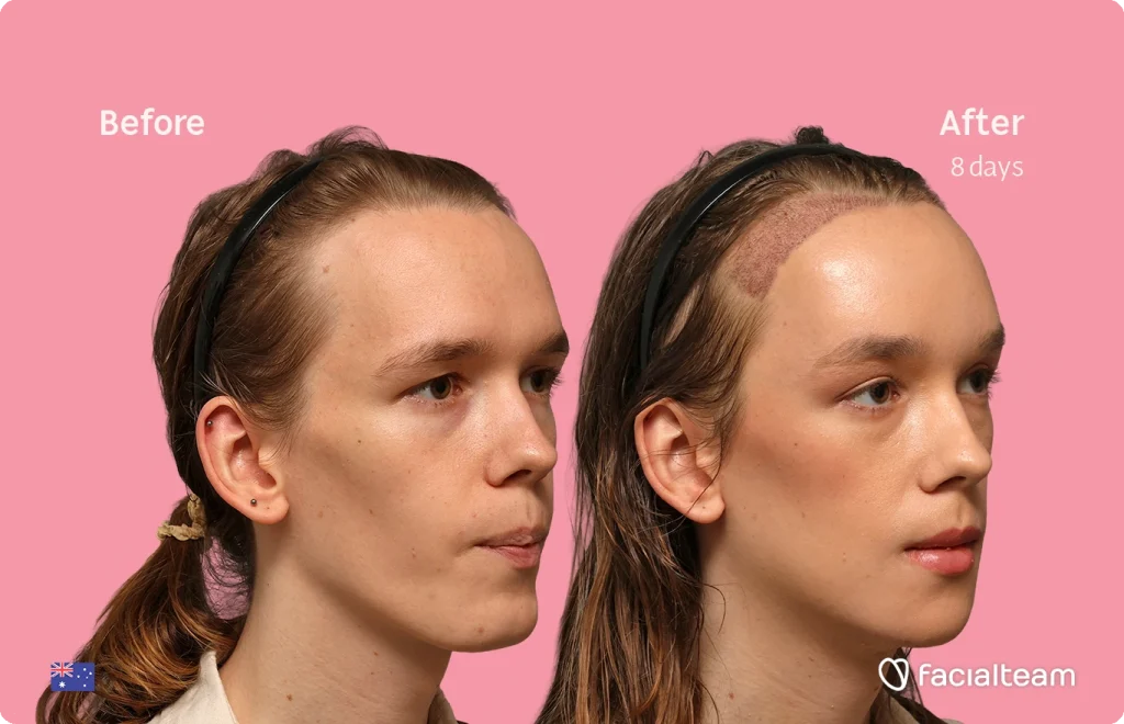 Side-by-side before-and-after photos of Mia’s face on a pink background, showing skin improvement after 8 days of treatment (Facial Team).