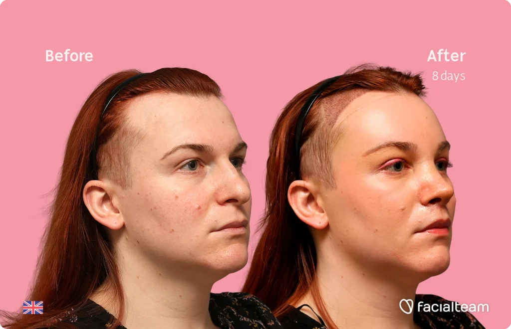 Before and after photo: side-by-side of a Mia with pink background, showing facial improvement after 8 days (left: skin with mild acne; right: clearer, smoother skin).