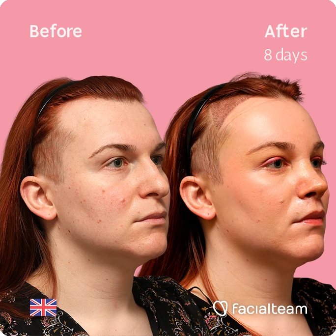 Side-by-side before and after portrait showing facial treatment results after 8 days, pink background, UK flag and Facialteam logo.