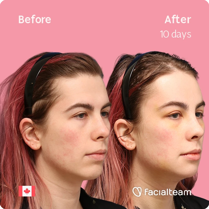 Side-by-side portrait of Elléonore before and after 10 days, showing improved skin on the right; pink background and Facials team branding.