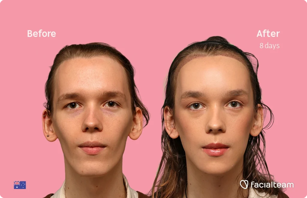 Side-by-side portraits labeled Before (left) and After 8 days (right) against a pink background, illustrating a skincare transformation. The Facialteam logo appears bottom-right.