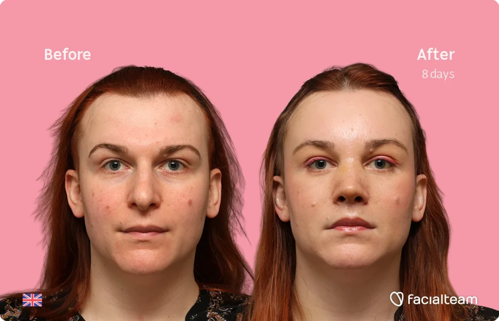Side-by-side before and after portrait showing clearer skin after 8 days of facial treatment, pink background (UK flag in corner).