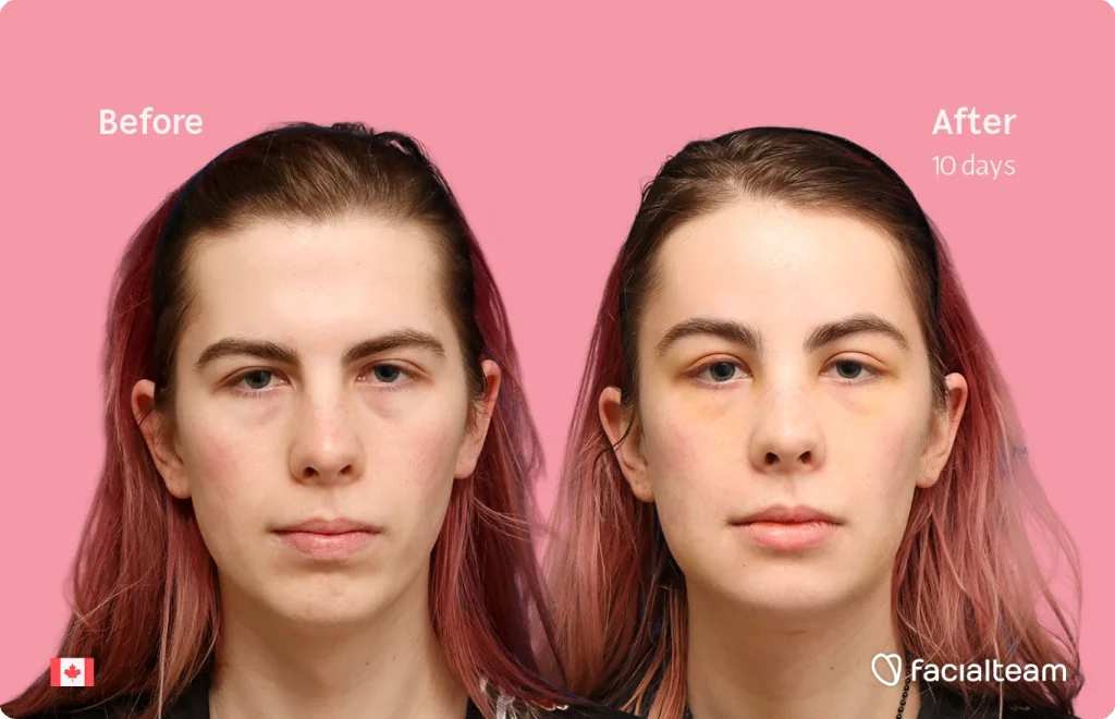 Before and after portrait on a pink background, left labeled 'Before' and right 'After 10 days' showing skin improvement.