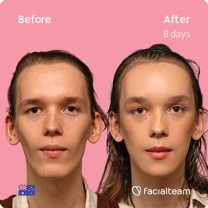 Side-by-side before and after photos of a cosmetic facial treatment showing improved skin in 8 days on a pink background; left: even-toned skin, right: smoother, brighter skin with subtle gloss; FacialTeam logo bottom right.