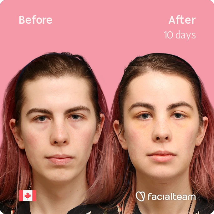 Side-by-side before and after portrait showing facial changes after 10 days; pink background, Canadian flag, Facialteam branding on bottom right/left.