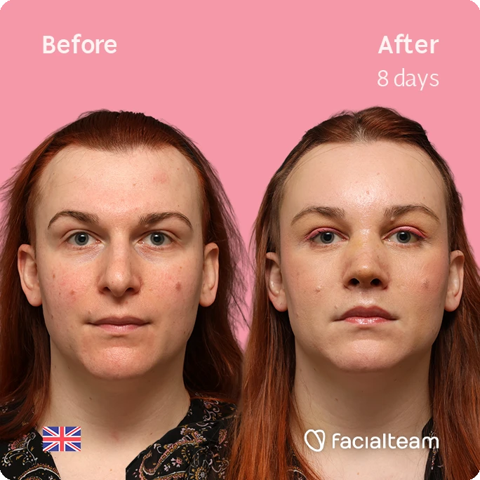 Before and after portrait of a woman showing acne improvement after 8 days on a pink background (Facialteam logo).
