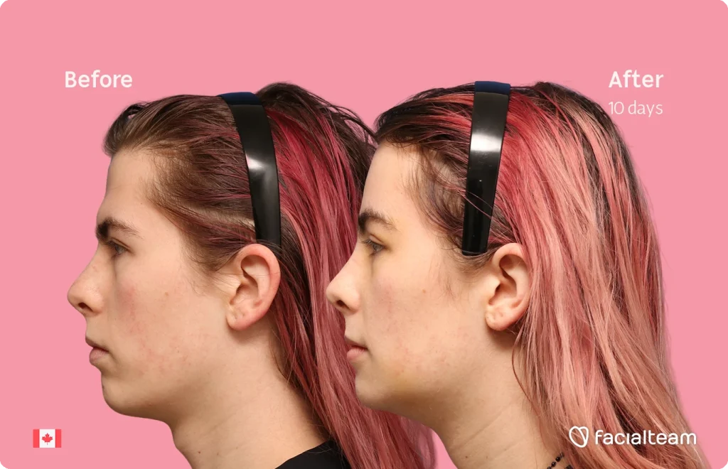 Side-by-side profile of Elléonore with pink hair wearing a black headband, labeled Before and After 10 days on a pink background.