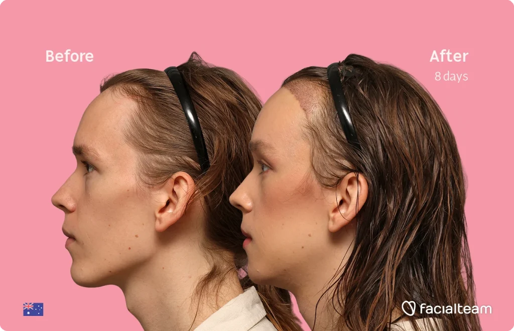 Side-by-side profile photos labeled Before and After (8 days) showing a Zoey's facial transformation, pink background, FacileTeam branding in the corner.