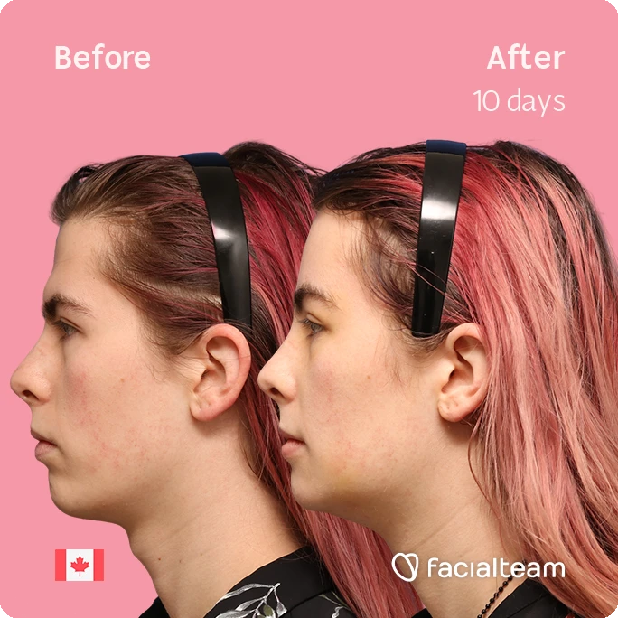 Before and after profile photos of Elléonore with pink hair, 10 days apart, showing facial contour change; left labeled 'Before', right labeled 'After 10 days'; pink background with Facialteam logo.