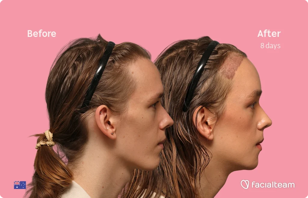 Side-by-side profile of a Zoey before and after a hair restoration treatment, pink background, showing healing scalp on the after side after 8 days.