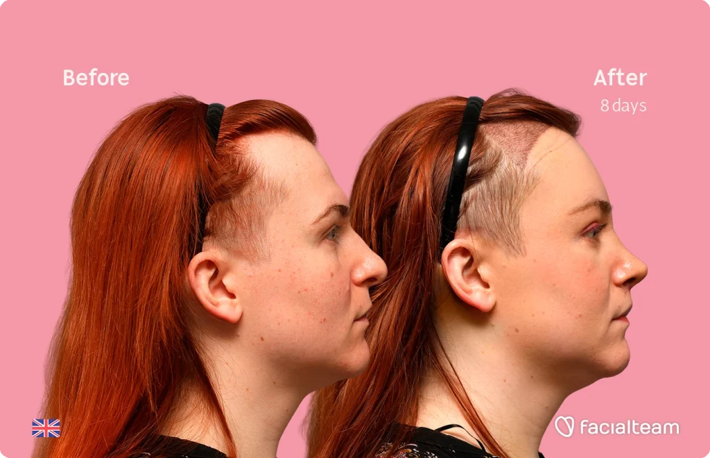 Before-and-after side-profile of a Mia against a pink background, showing hair transplant progress at eight days: left 'Before' with longer hair, right 'After' with shaved sides and longer top.