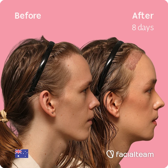 Side-by-side profile photos of a Zoey before and after treatment; left shows initial condition, right shows healing scar on the temple after 8 days on a pink background with the Facialteam logo.