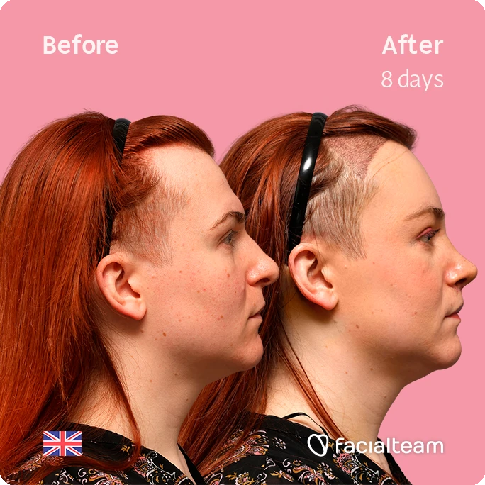 Side-by-side profile photos of a Mia before (left) and after eight days of treatment (right) against a pink background, illustrating the progress.