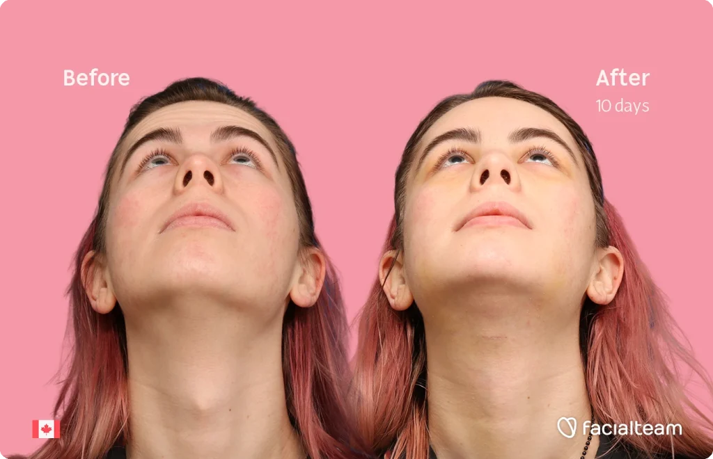 Before-and-after photo of a young Elléonore’s face and neck showing results after 10 days of treatment; pink background and facialteam logo visible.