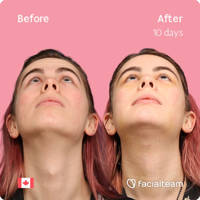 Side-by-side before-and-after photo of Elléonore's face looking upward, showing cosmetic treatment results after 10 days (pink background).
