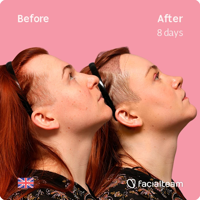 Side-by-side profile of a Mia; left shows before, right shows after 8 days, pink background, UK flag bottom left, facialteam watermark bottom right.