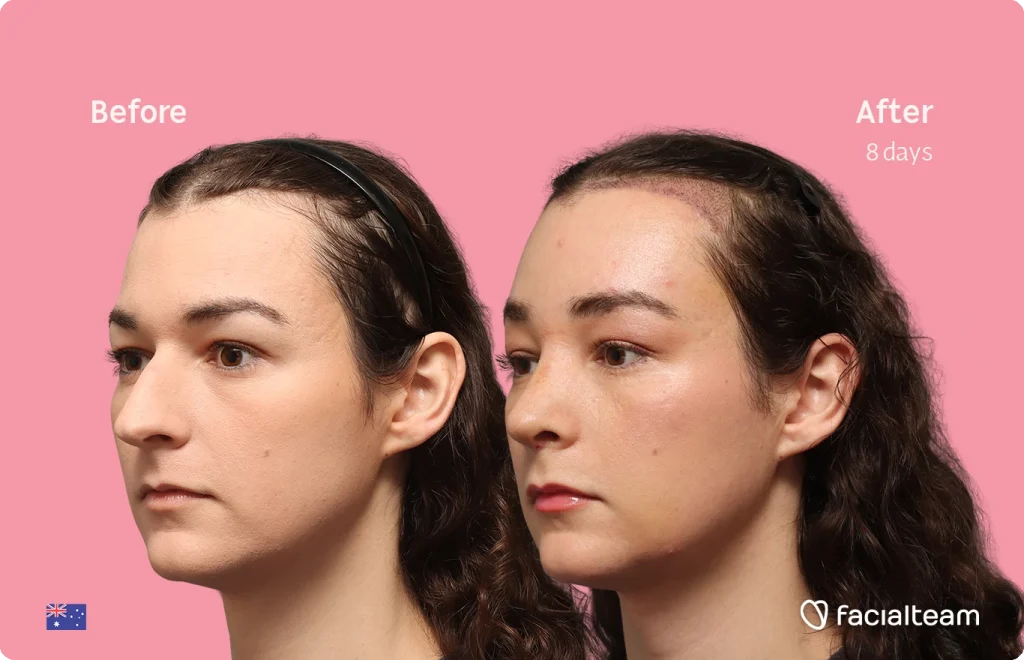 Side-by-side photos of a woman’s face on a pink background, labeled 'Before' (left) and 'After 8 days' (right), showing skin healing progress along the hairline.