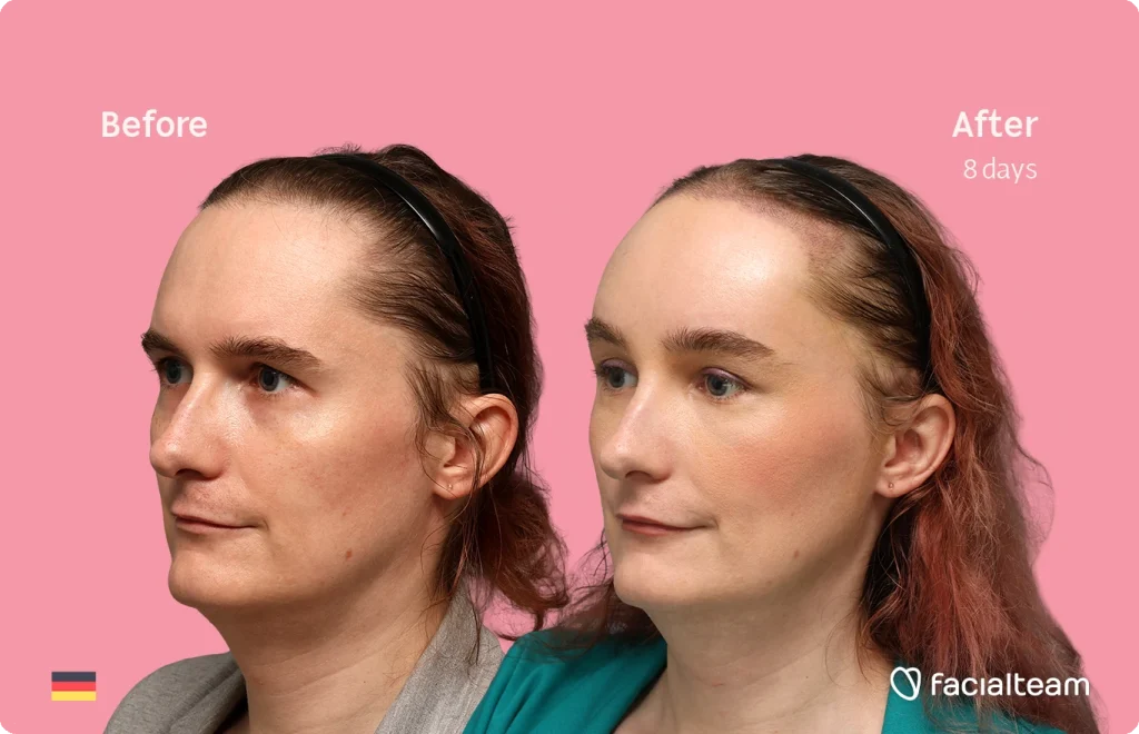 Side-by-side portraits of a woman labeled Before and After 8 days of treatment on a pink background; German flag at bottom left and Fac ialteam logo at bottom right.