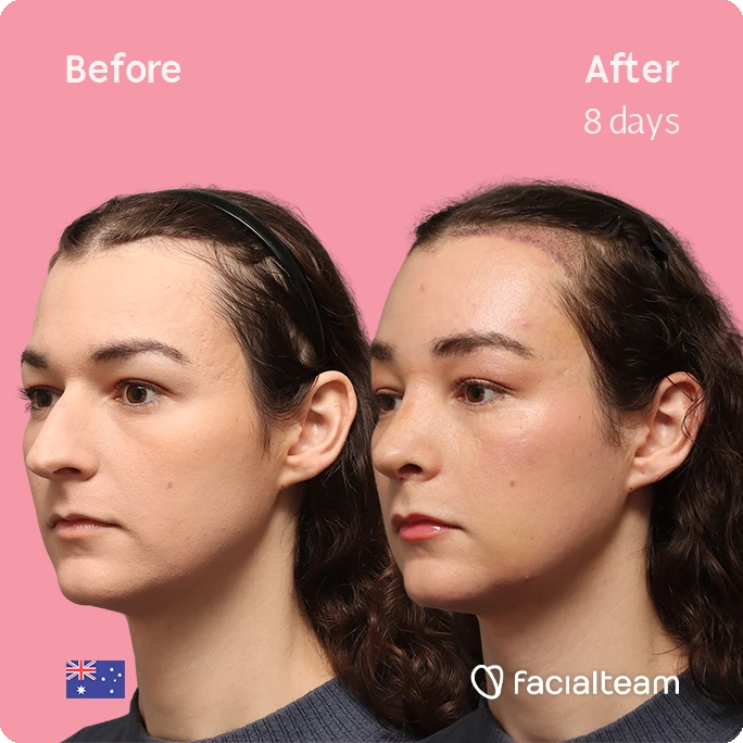 Side-by-side profile photos showing before and 8 days after a facial treatment, pink background, with facialteam branding.
