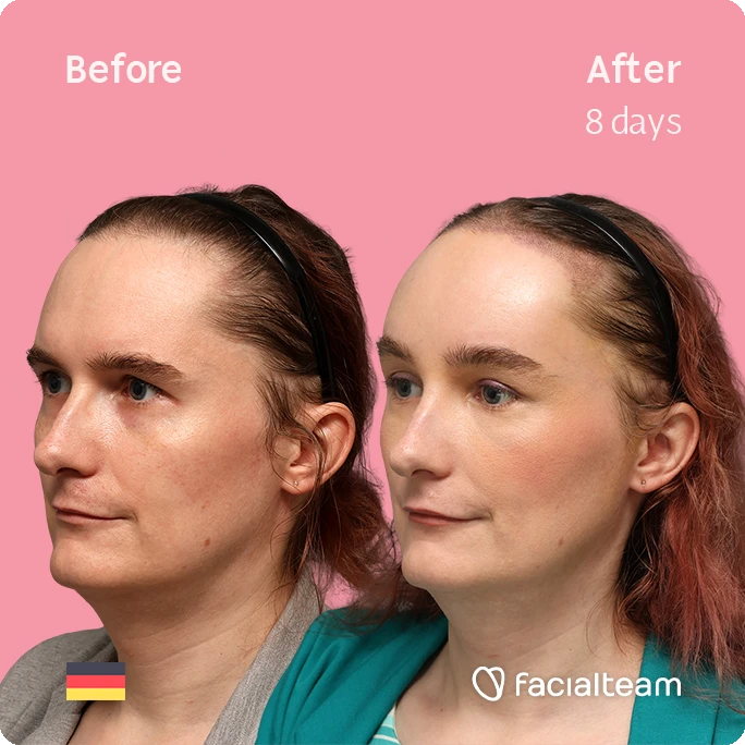 Side-by-side portrait of a woman's face on a pink background, left labeled 'Before' and right labeled 'After 8 days', illustrating cosmetic treatment results; Faciliateam logo bottom right.