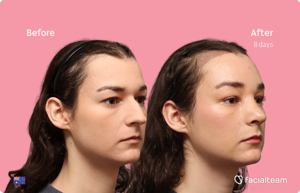 Side-by-side profile: left 'Before' and right 'After 8 days' showing clearer skin on the right against a pink background.