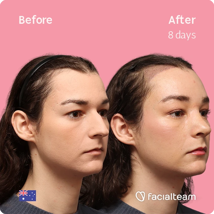 Before-and-after comparison of a woman's face over 8 days, showing smoother skin and improved contour; pink background with Facailteam branding.