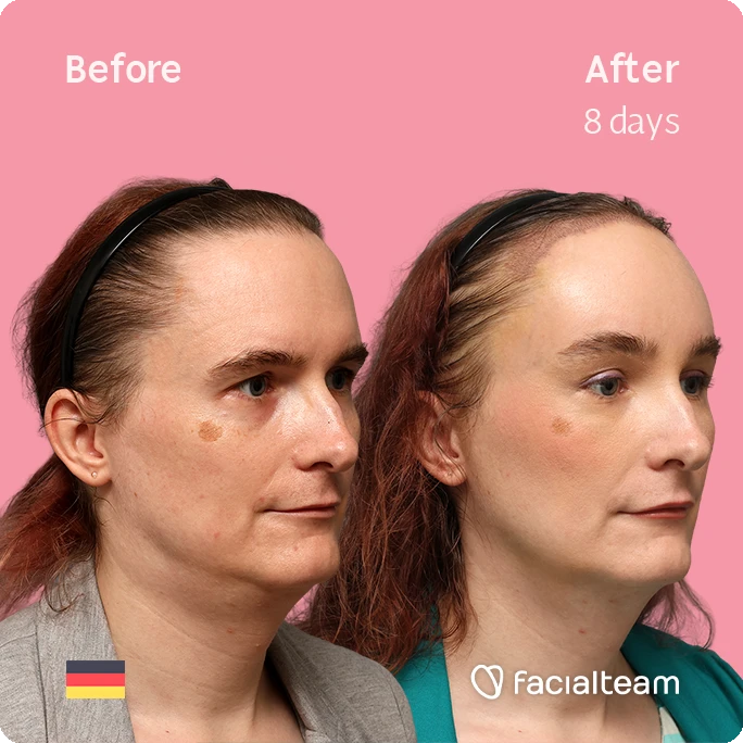 Side-by-side comparison of a woman's face before (left) and after 8 days of treatment: fewer dark spots and smoother skin; pink background, Facailteam logo.