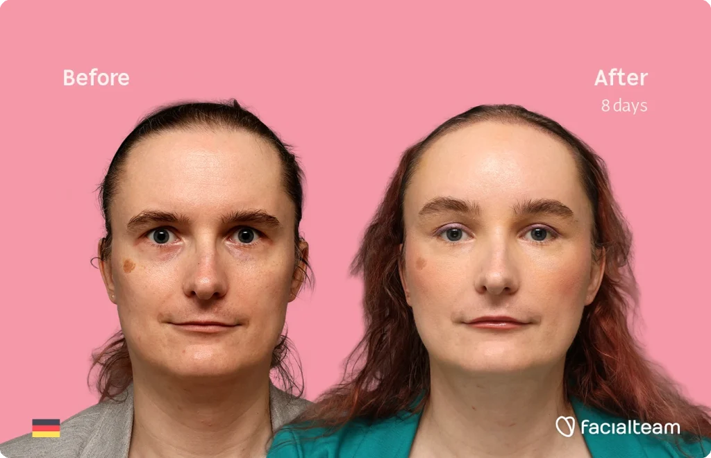 Before and after comparison of a woman's face after 8 days of treatment, pink backdrop, brand logo bottom right (facialteam)